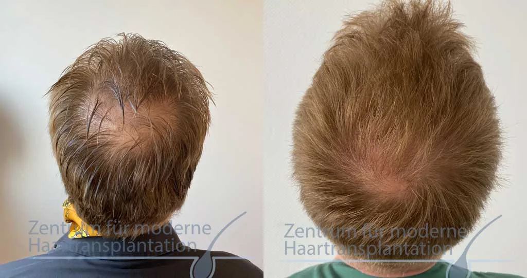 PRP-Behandlung der Kopfhaut, Vorher und Nachher, Fall 10