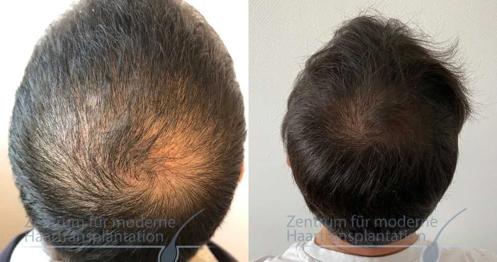 PRP-Behandlung der Kopfhaut, Vorher und Nachher, Fall 15