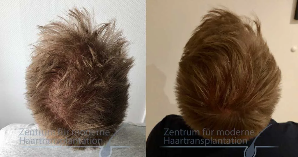 PRP-Behandlung der Kopfhaut, Vorher und Nachher, Fall 16